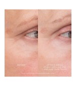 Equilibrium Resurfacing Retinoid Treatment