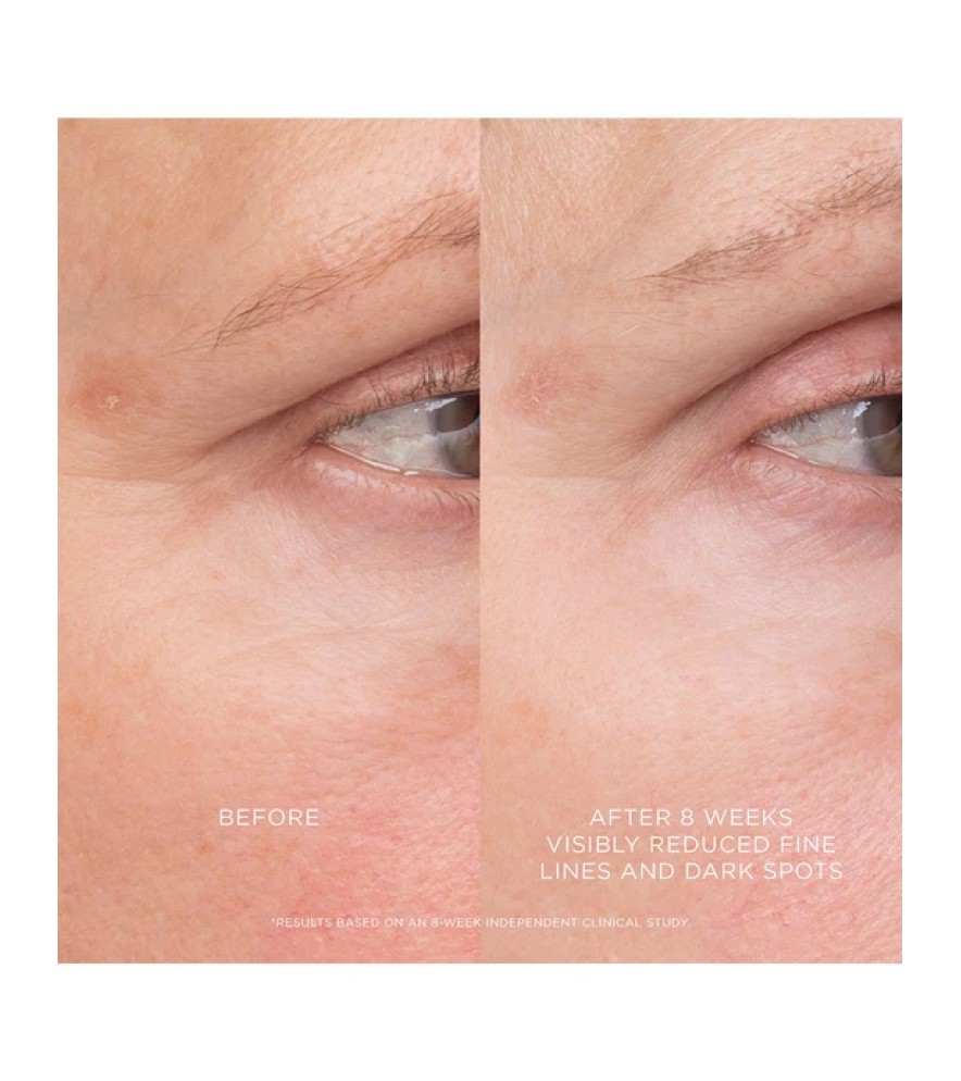 Equilibrium Resurfacing Retinoid Treatment